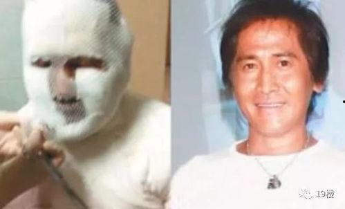 被火罐烧伤 明星,明星意外受伤背后的故事